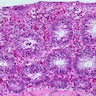 Eosinophilic Colitis