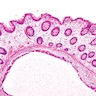 Pathology Outlines - Pneumatosis cystoides intestinalis