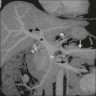 Coronal CT of normal portal venous system