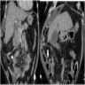 Dilated mesenteric vessels and bowel thickening