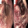 Sigmoidoscopy showing ulcers and necrosis