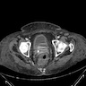 Radiation proctitis