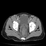 Mpox proctitis