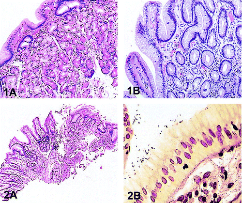 Pathology Outlines - Ectopic gastric tissue