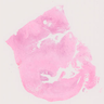Inflamed, ulcerated fallopian tube