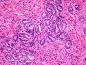 Pathology Outlines - Mesonephric duct remnants