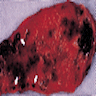 Pathology Outlines - Adenomyomatous hyperplasia