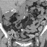 CT with calcifications and stones