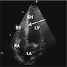 Mid apical hypertrophy (arrow)