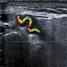 Giant cell arteritis involving temporal artery