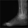 Xray ankle showing osteoarthritis, osteopenia and periarticular calcification