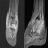 Synovial thickening, chondromatosis bodies in joints