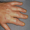 Swelling of PIP and MCP joints of the hand
