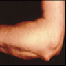 Rheumatoid nodule