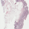 Synovial pannus