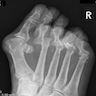 Xray, forefoot