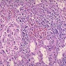 Pathology Outlines - Acute pyelonephritis