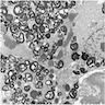 Electron microscopic changes in Fabry disease