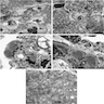 Myelin-like inclusions in podocyte cytoplasm