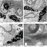 Lamellated inclusions in glomerulus