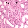 Pathology Outlines - Light chain cast nephropathy