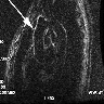 ECG gated double inversion recovery