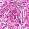 Pathology Outlines - Rapidly progressive (crescentic) glomerulonephritis