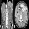 Bilateral inhomogeneous lesions