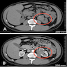 CT and MRI showing left renal mass in a horseshoe kidney