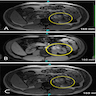 CT and MRI showing left renal mass in a horseshoe kidney