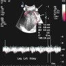 Ultrasound, heterogeneous hyperechoic mass