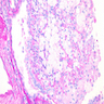 Foamy histiocytes and inflammatory cells