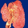 Macronodular cirrhosis