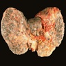 Macronodular cirrhosis