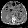 Cirrhosis secondary to HCV