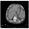 CT cirrhotic liver, ascites