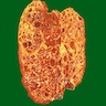 ADPKD patient