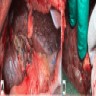 Enlarged and nodular liver