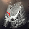 Hyperechoic pipestem fibrosis