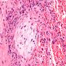 Pathology Outlines - Cryptogenic organizing pneumonia