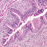 Pathology Outlines - Bronchiectasis