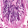 Pathology Outlines - Bronchiectasis