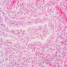 Pathology Outlines - Bronchiectasis