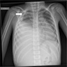 CXR, CT PPB type III