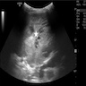 CXR, CT PPB type III