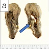 Mucinous nodule in right lower lobe measuring 20 mm