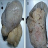 Papillary adenoma connected to the pleura