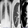 Chest Xray and CT scan of bronchial adenoma / CMPT