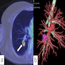 FDG PET CT of bronchial adenoma / CMPT