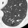 CT scan of CMPT